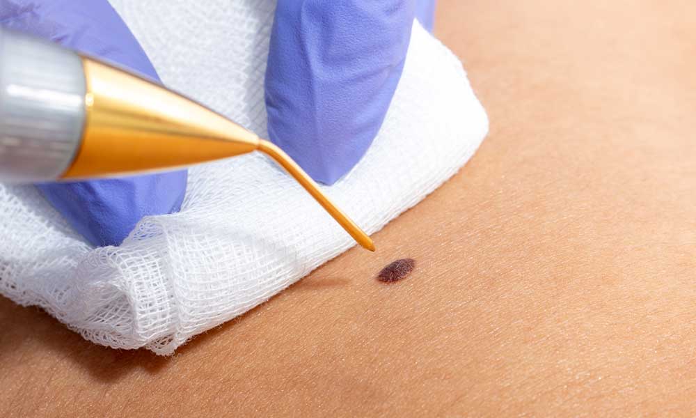 Plasma Pen Tedavisi Sonrası Kabuklanma ve İyileşme Süreci