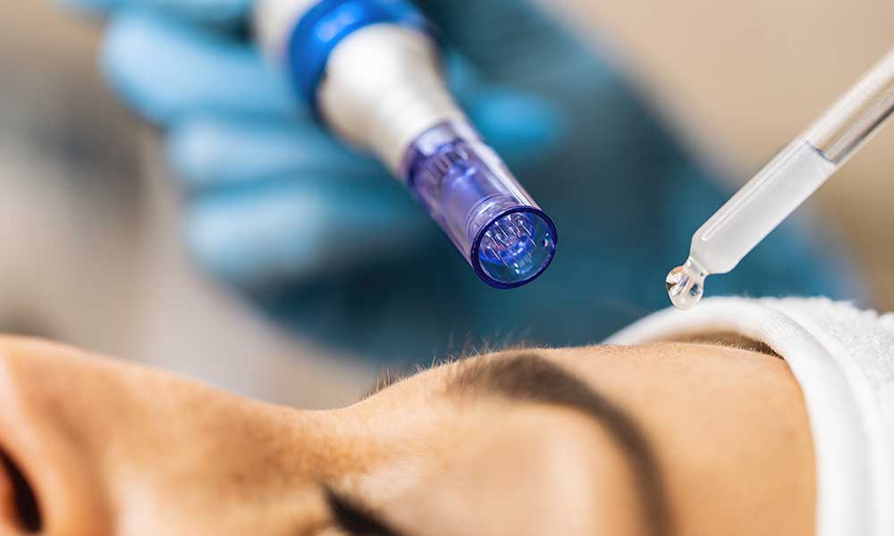 Dermapen İşlemi ve Avantajları
