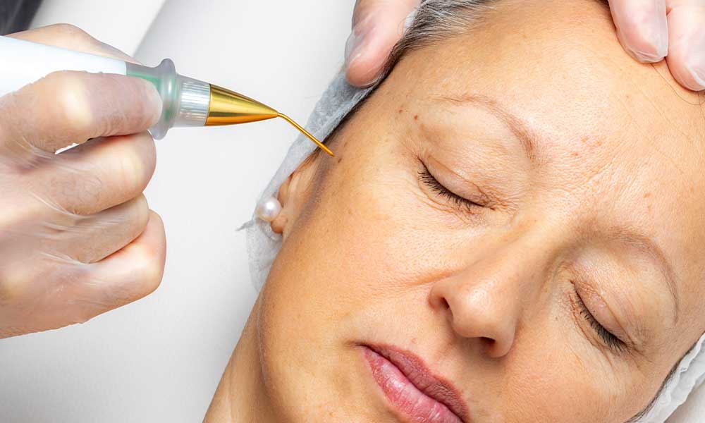 Plasma Pen Tedavisi Nedir? Cilt Sıkılaştırma ve Lekeleri Azaltma